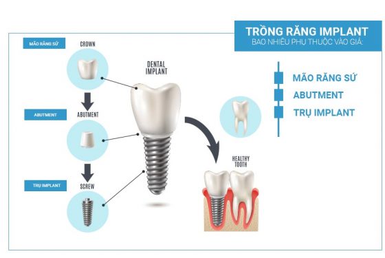 Trồng răng Implant