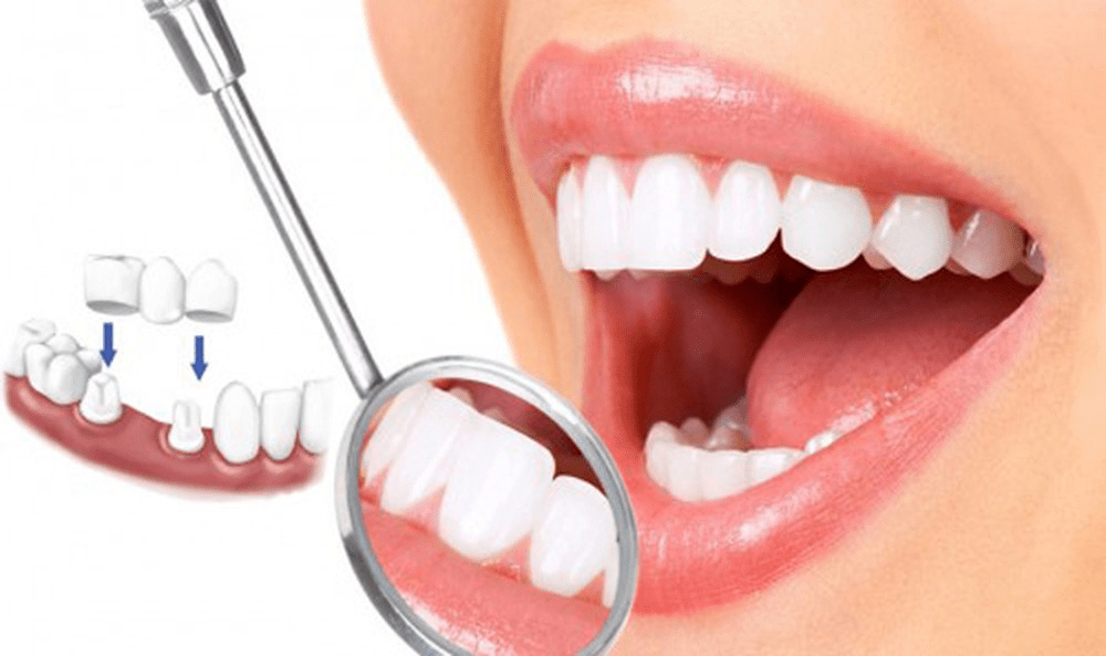 Bọc răng sứ bao lâu thì hỏng? Có cần phải thay lại không?