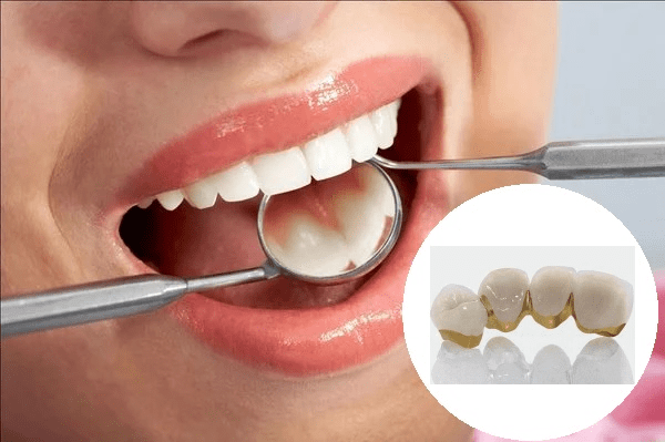 Bọc răng sứ kim loại có bền không?