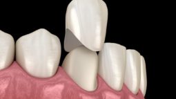 Có nên bọc răng sứ ở bệnh viện Răng hàm mặt Trung ương không?