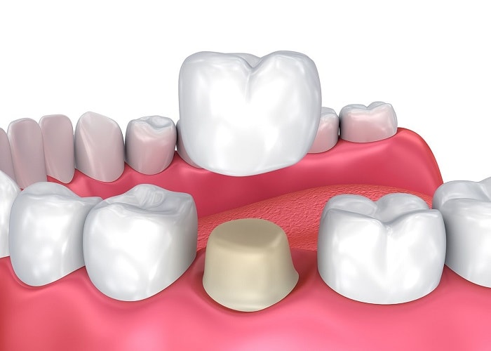 6 Hậu quả nghiêm trọng khi bọc răng sứ kém chất lượng