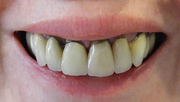 Hậu quả bọc răng sứ gây ảnh hưởng đến sức khỏe răng