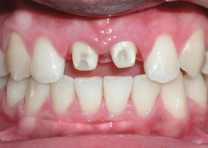 Mài răng quá sâu dẫn đến viêm tủy, làm hỏng răng thật