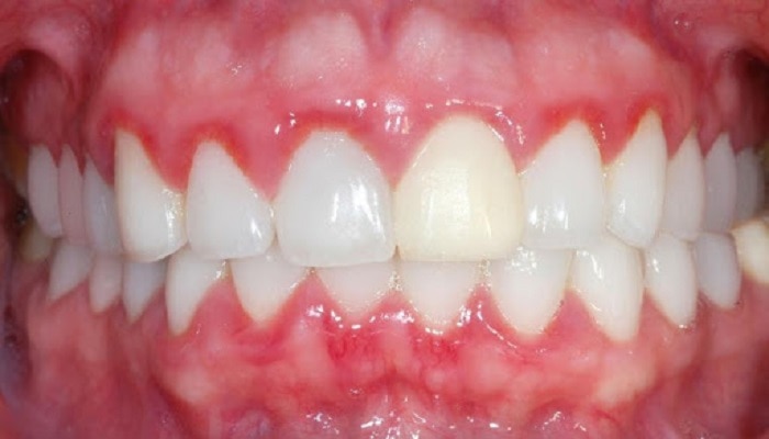 Viêm lợi là biểu hiện của bọc răng sứ sai tỷ lệ