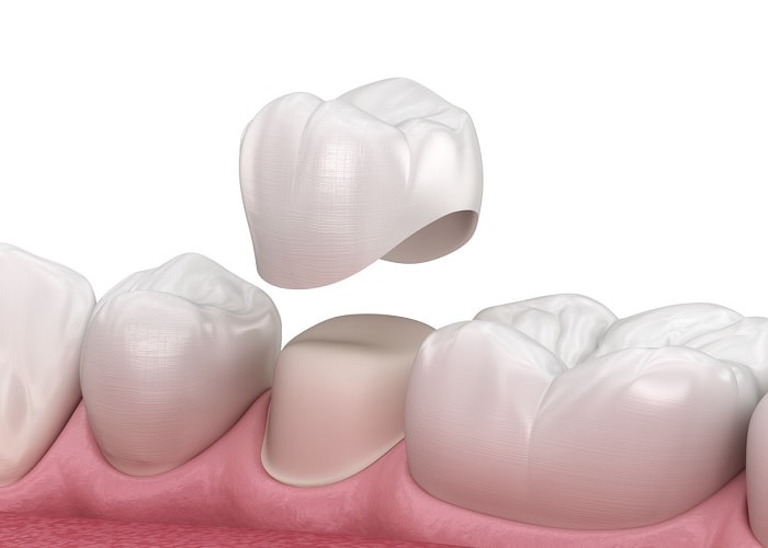 Bệnh viện răng hàm mặt trung ương có dịch vụ bọc răng sứ uy tín
