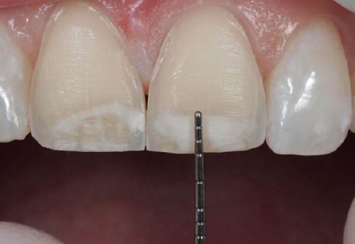 Mài răng quá sâu gây ảnh hưởng nghiêm trọng đến răng thật