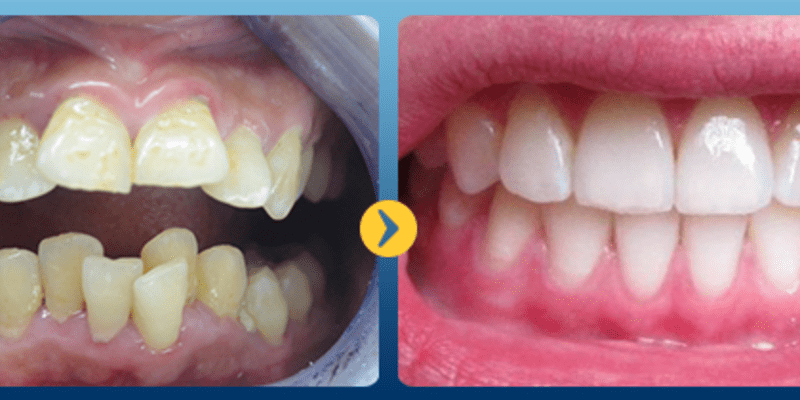 Bọc răng sứ cho răng hô được đánh giá cao trong việc khắc phục nhược điểm