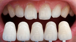 Bọc sứ răng cửa bị lệch có nguy hiểm không?
