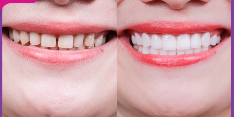 Bọc sứ răng cửa bị lệch có cần phải lấy tủy răng không?