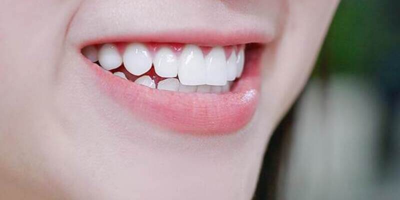 Tính thẩm mỹ của răng sau khi được bọc sứ răng cửa bị lệch nâng cao thấy rõ