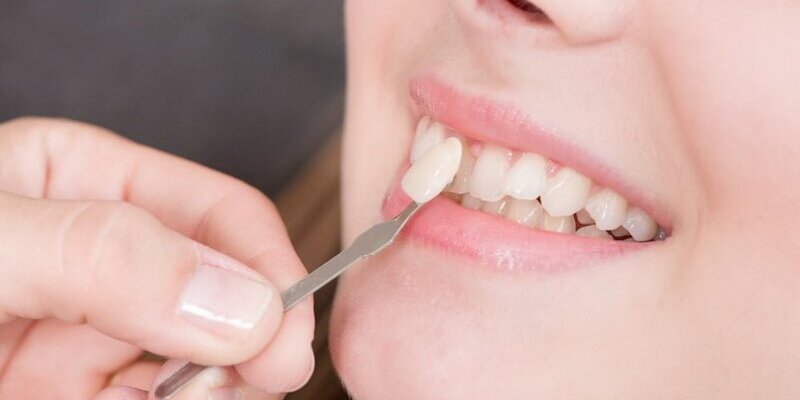 Chất liệu bọc răng sứ cho răng cửa có khá nhiều, bạn nên cân nhắc lựa chọn cho phù hợp với nhu cầu