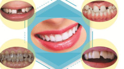 Khi nào nên bọc răng sứ và đâu là các chất liệu phổ biến?