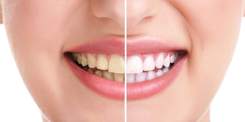 Khi nào nên bọc răng sứ để sở hữu hàm răng trắng sáng, đều màu dễ dàng, nhanh chóng