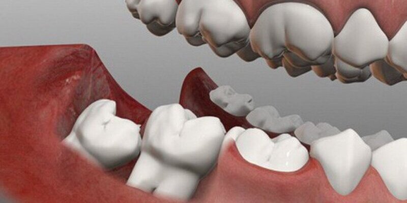 Khi nào nên bọc răng sứ để cải thiện răng mọc lệch