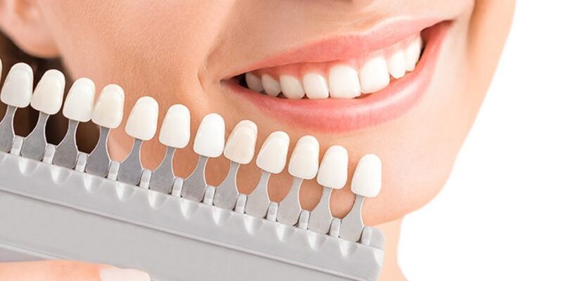 Khi nào nên bọc răng sứ để phục hồi khuyết điểm răng