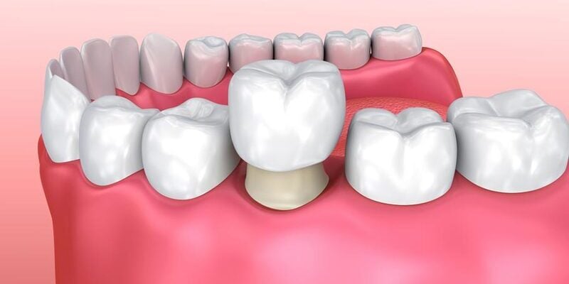 Tất tần tật các kinh nghiệm bọc răng sứ thú vị
