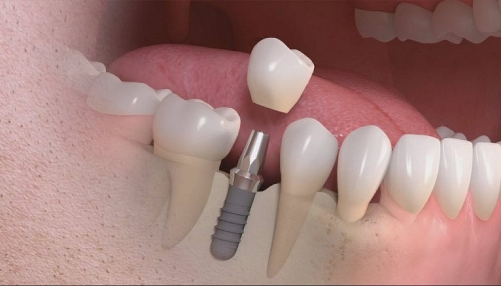 kinh nghiệm trồng răng implant