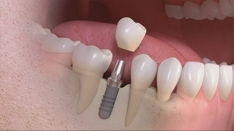 Top 5 kinh nghiệm trồng răng Implant cần nằm lòng
