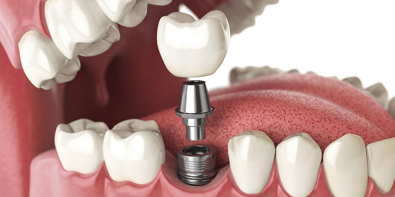 Trồng răng Implant có niềng được không