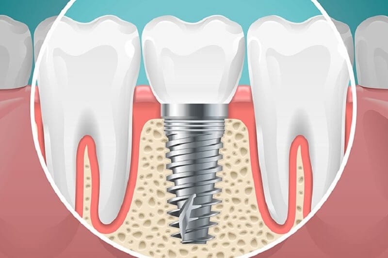 Trồng răng implant là phương pháp phục hình răng bị mất hiệu quả nhất hiện nay