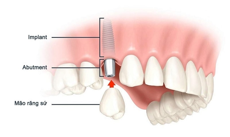 Sau nhổ răng bao lâu thì trồng implant là thích hợp