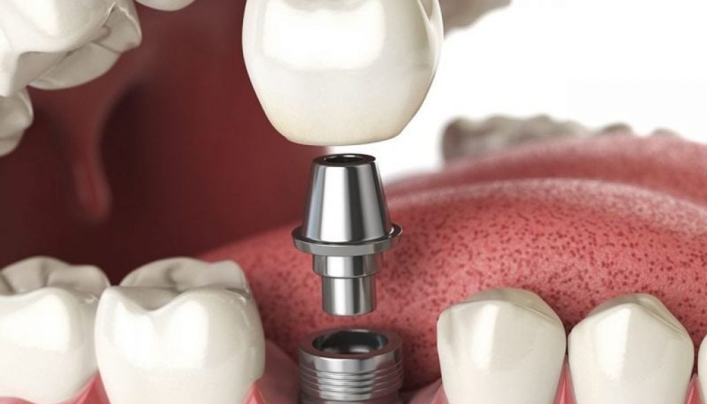 sau khi nhổ răng bao lâu thì trồng implant