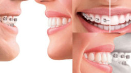 Răng lệch lạc nên niềng hay bọc sứ?
