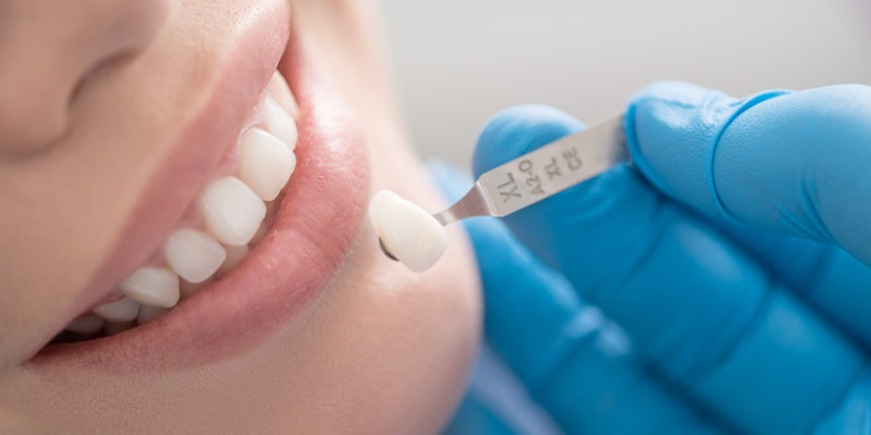 Bọc răng sứ sở hữu ưu điểm làm đều răng và trắng sáng nhanh chóng