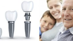Trồng răng Implant cho người già và những điều cần biết