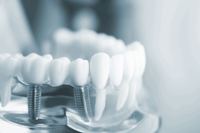 Chi phí trồng răng Implant cho người già khá cao