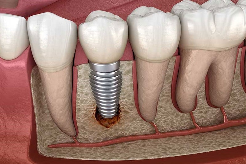 Trồng răng implant có bền không còn dựa vào nhiều yếu tố