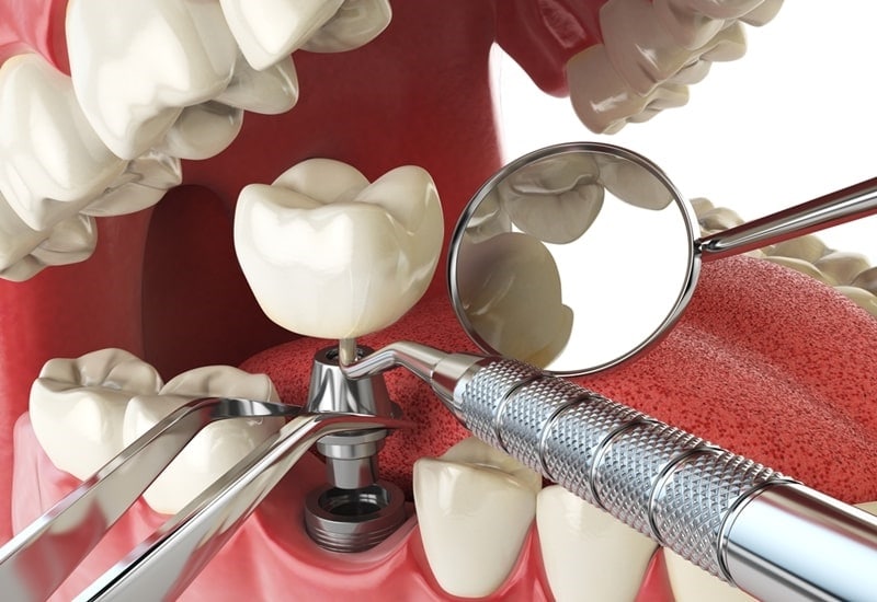 Trồng răng implant có bền không dựa vào tay nghề bác sĩ