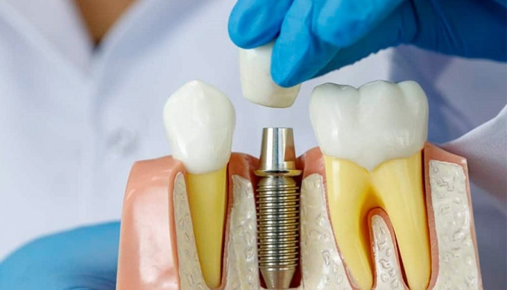 trong-rang-implant-co-ben-khong-thumb trồng răng implant có bền không
