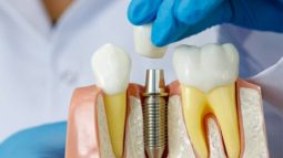 Trồng răng implant có bền không? Các yếu tố ảnh hưởng tới tuổi thọ răng implant?
