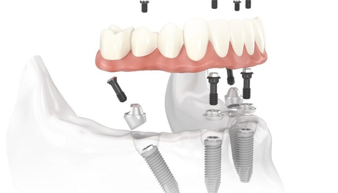 trồng răng implant có niềng được không