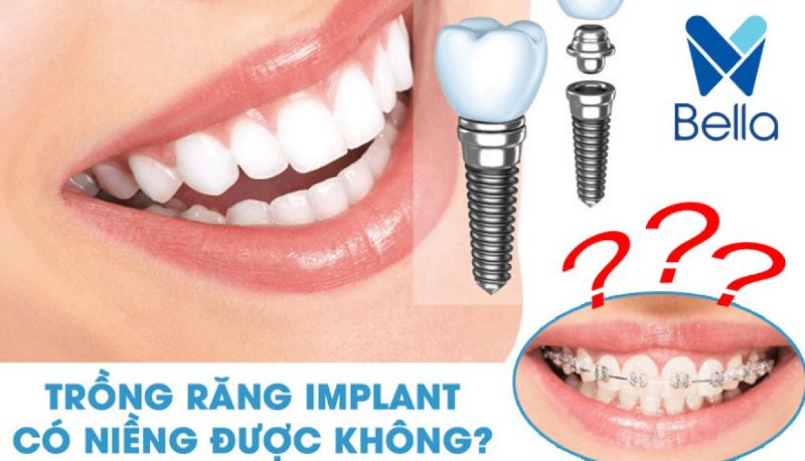 Trồng răng Implant có niềng được không? Cần lưu ý gì?