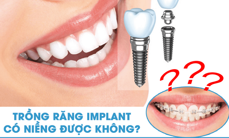 Tùy từng trường hợp mà sau trồng răng Implant có thể niềng hoặc không