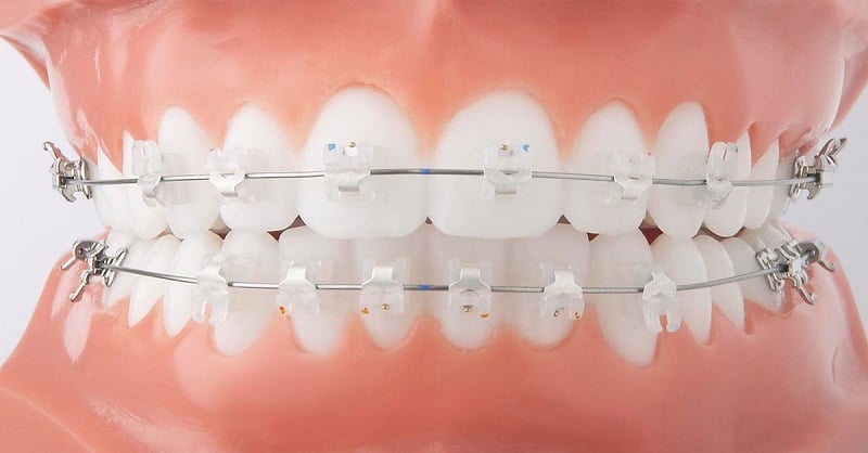 Niềng răng sau khi trồng răng Implant cần thực hiện tại cơ sở nha khoa uy tín