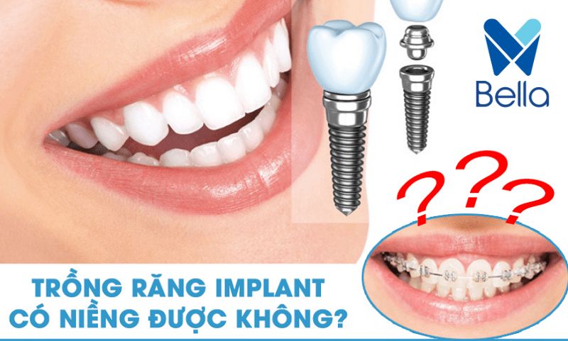 Trồng răng Implant có niềng được không? Cần lưu ý gì?