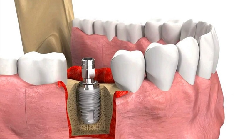 Trồng răng implant là kỹ thuật phức tạp