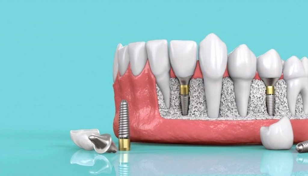 Trồng răng implant ở bệnh viện răng hàm mặt trung ương có tốt không?