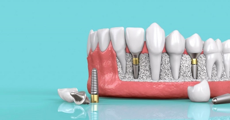 Trồng răng implant ở bệnh viện răng hàm mặt trung ương có tốt không?