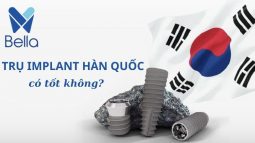 trồng răng implant hàn quốc có tốt không