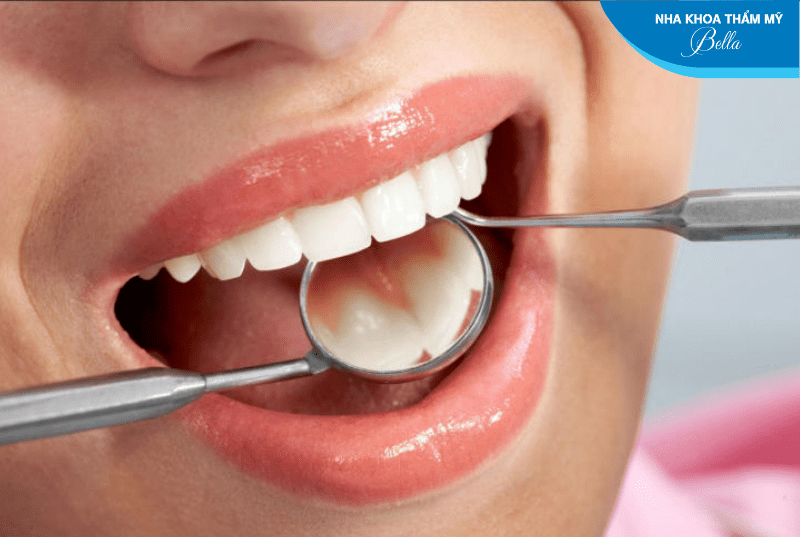 Cạo vôi răng định kỳ giúp giảm nguyên nhân gây hôi miệng