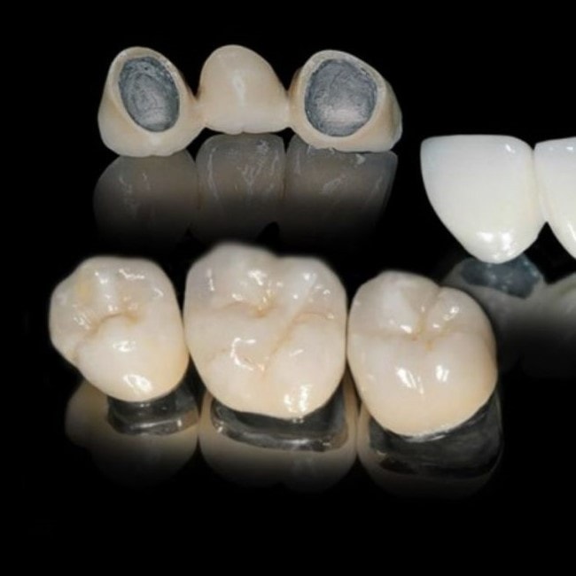 Răng sứ kim loại là một trong các loại răng sứ tốt được nhiều người lựa chọn