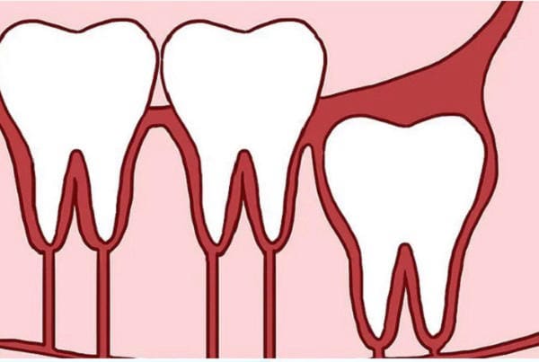 Một trong các trường hợp răng khôn mọc lệch cần phải nhổ