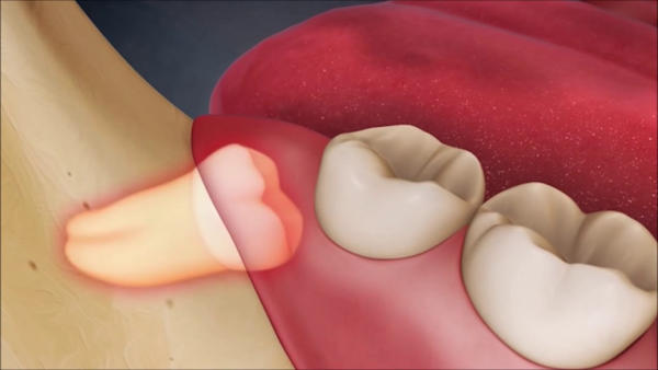 Răng mọc kẹt là một trong các trường hợp răng khôn mọc lệch