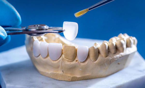 Quy trình dán răng sứ veneer chuyên nghiệp tại nha khoa Bella