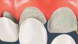 Dán răng sứ veneer giúp răng trắng đẹp mà không cần mài