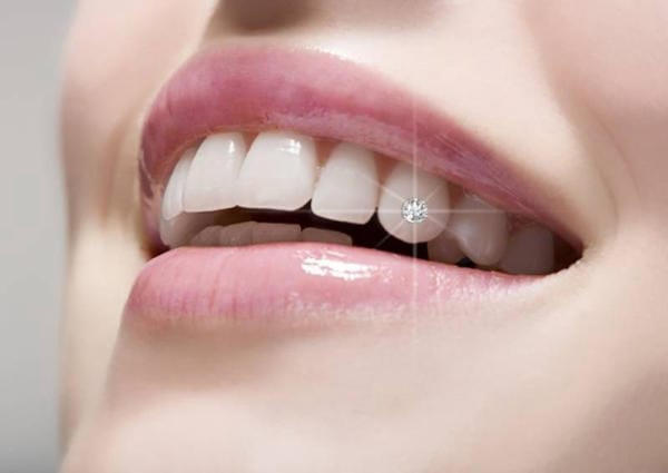 Đính đá vào răng giúp nụ cười đẹp hơn và có điểm nhấn